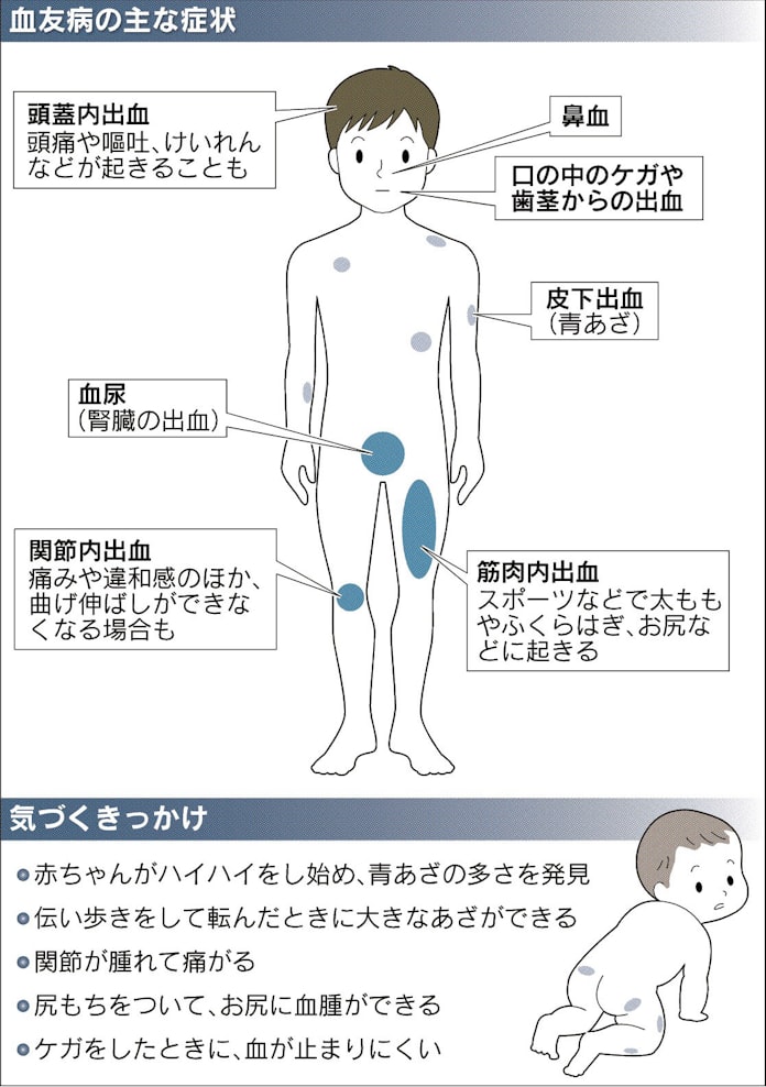 血友病 新薬で負担軽減 日本経済新聞 血友病 新薬で負担軽減 日本経済新聞