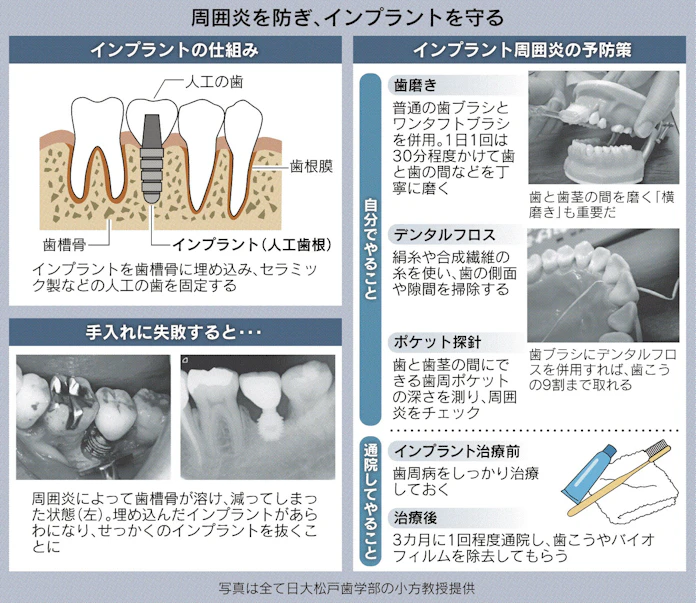 治療前後の手入れ怠ると インプラント 抜けるかも 日本経済新聞