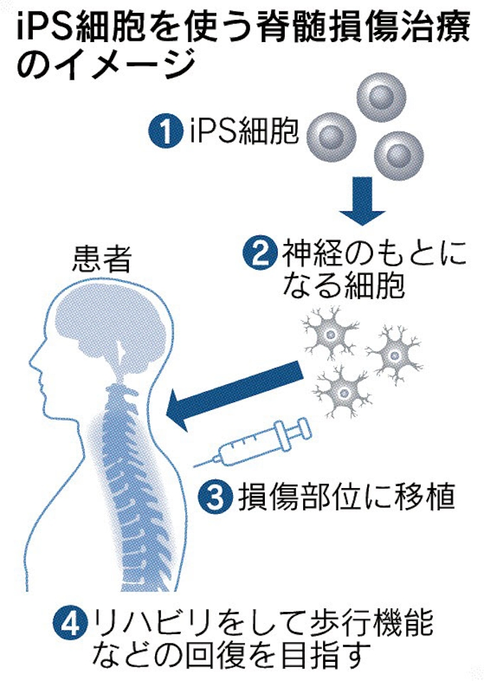 Ipsで脊髄治療 厚労省了承 日本経済新聞