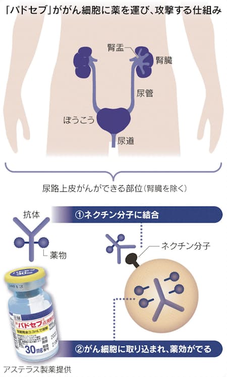 進行ぼうこうがんに新薬 従来薬効かない患者に効果 日本経済新聞 進行ぼうこうがんに新薬 従来薬効かない患者に効果 日本経済新聞