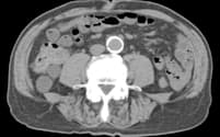 腎機能の低下によって腹部大動脈が硬化してしまった患者の腹部の画像。中心の丸い部分が血管で周りが石灰化している=椿原美治阪大教授提供