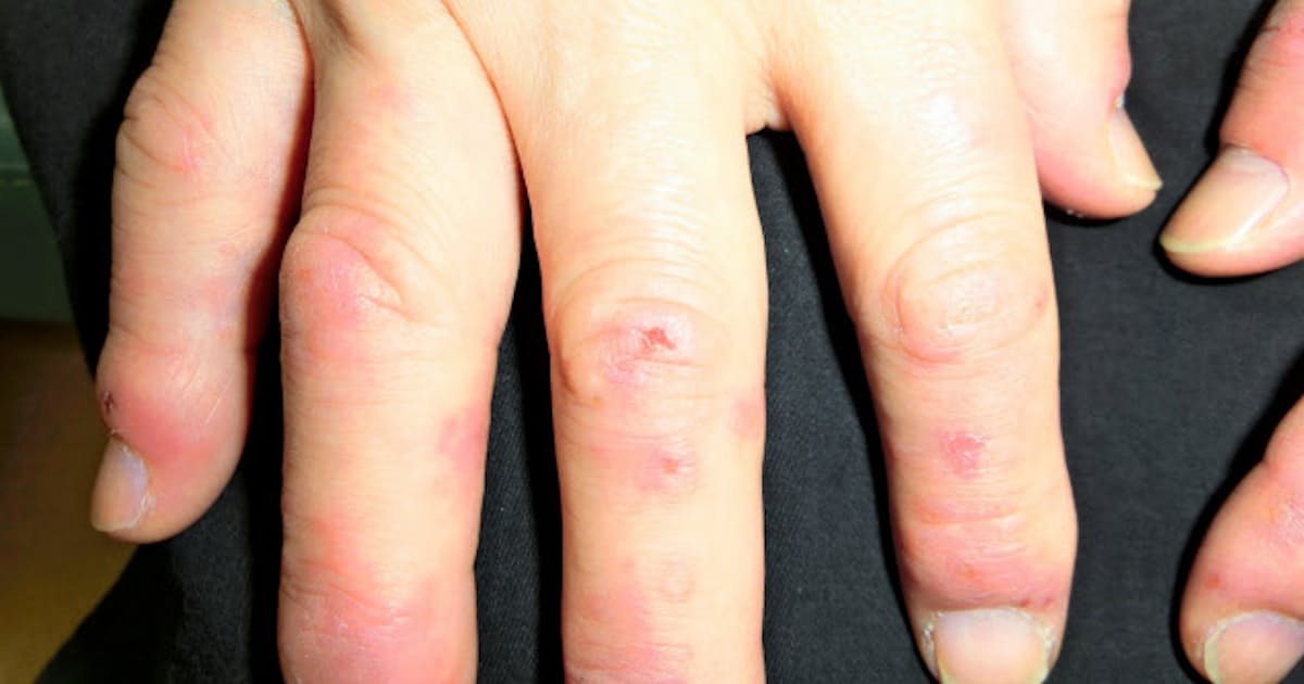 しもやけ 春先にも 日本経済新聞 しもやけ 春先にも 日本経済新聞