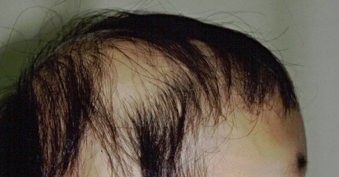 突然現れて驚く 円形脱毛症 日本経済新聞