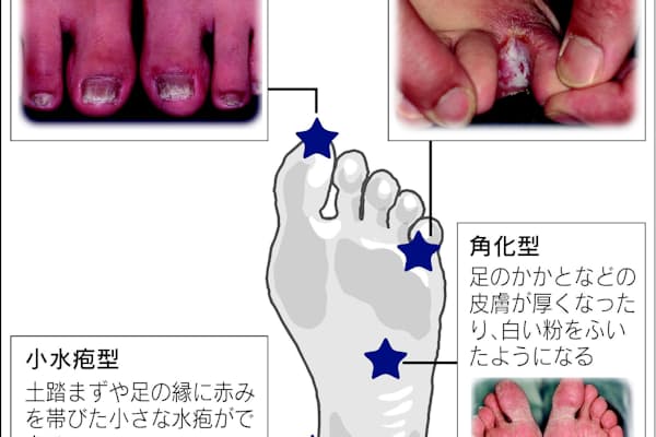 足だけではない 感染力強い水虫の菌が頭や体に Nikkei Style 足だけではない 感染力強い水虫の菌が頭や体に Nikkei Style