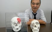 ネクスト21の鈴木茂樹社長と3D印刷した人工骨を埋め込んだ頭蓋骨の模型