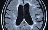 多発性硬化症の患者の脳を撮影した磁気共鳴画像装置（MRI）画像。中心の脳室に当たる空洞が大きくて脳が萎縮しており、白い病変がある（東北大学提供）