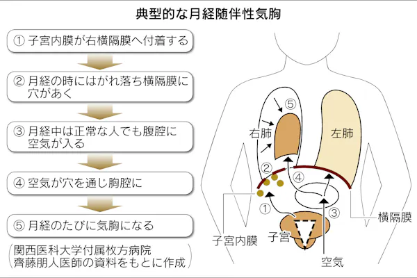 肺に穴 息苦しい 気胸はストレス 寝不足も原因 Nikkei Style