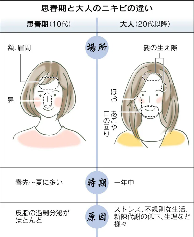 大人のニキビ 体調映すバロメーター Nikkei Style 大人のニキビ 体調映すバロメーター Nikkei Style