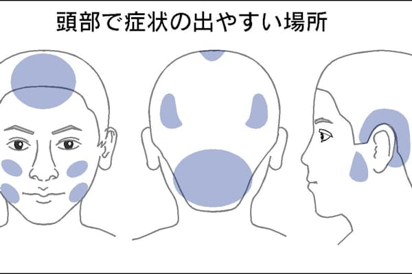 足だけではない 感染力強い水虫の菌が頭や体に Nikkei Style 足だけではない 感染力強い水虫の菌が頭や体に Nikkei Style