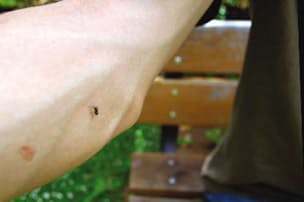 虫刺されに2タイプ あとで腫れる場合は処方薬を Nikkei Style 虫刺されに2タイプ あとで腫れる場合は処方薬を Nikkei Style