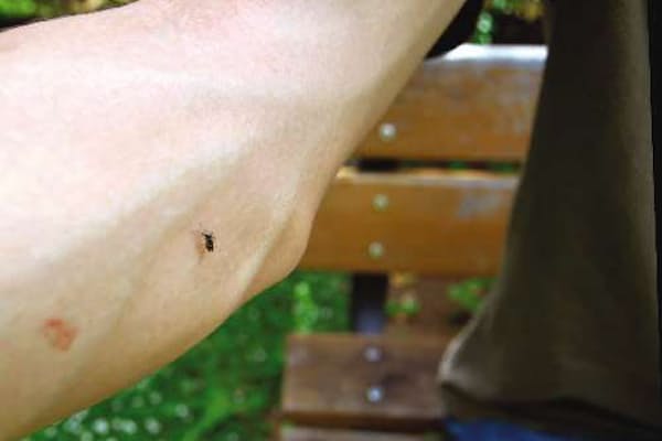 虫刺されに2タイプ あとで腫れる場合は処方薬を Nikkei Style 虫刺されに2タイプ あとで腫れる場合は処方薬を Nikkei Style