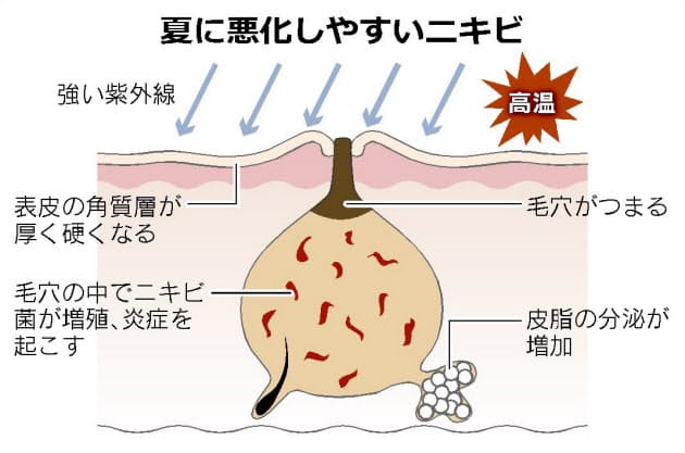 夏はニキビに注意 1日2回しっかり洗顔 Nikkei Style 夏はニキビに注意 1日2回しっかり洗顔 Nikkei Style
