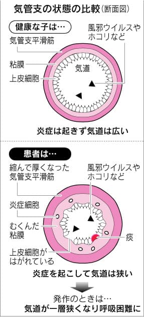 小児喘息 乳幼児ご用心 Nikkei Style