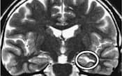 左脳の海馬が硬化（丸で囲んだ部分）して、発作の焦点となった患者のMRI画像
=堀名誉院長提供
