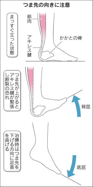 アキレス腱断裂 30 40代で多発 日常生活でも発生 Nikkei Style アキレス腱断裂 30 40代で多発 日常生活でも発生 Nikkei Style
