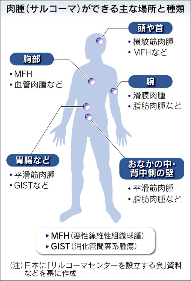 肉腫 治療法確立へ一歩 専門センター開設 新薬も登場 Nikkei Style 肉腫 治療法確立へ一歩 専門センター開設 新薬も登場 Nikkei Style