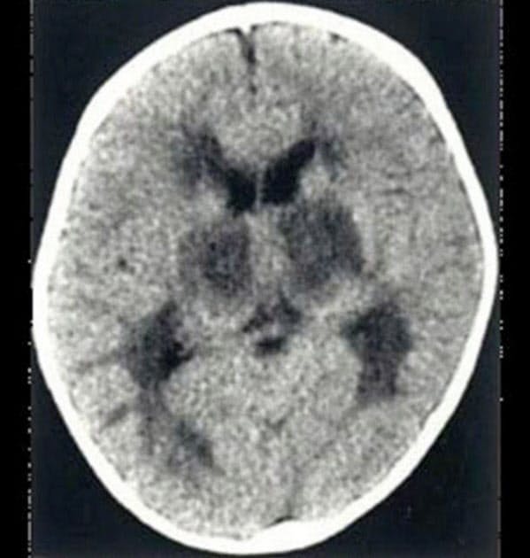 インフルエンザ脳症に注意 乳幼児 けいれん続けば受診を Nikkei Style