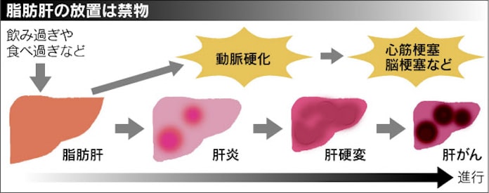 飲み過ぎ食べ過ぎ 脂肪肝になりやすく 肝硬変 がんのリスク上昇 日本経済新聞 飲み過ぎ食べ過ぎ 脂肪肝になりやすく 肝硬変 がんのリスク上昇 日本経済新聞