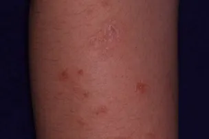 7割が原因不明 じんましん ストレスも影響 Nikkei Style 7割が原因不明 じんましん ストレスも影響 Nikkei Style