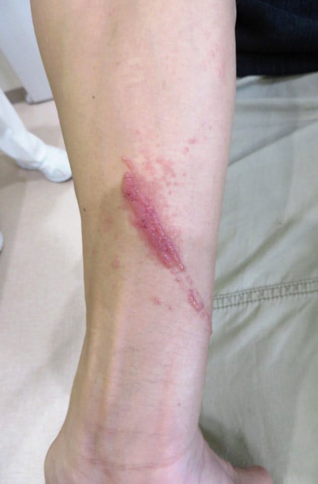 夏は やけど虫 に注意 アリ似 触ると水ぶくれ Nikkei Style 夏は やけど虫 に注意 アリ似 触ると水ぶくれ Nikkei Style