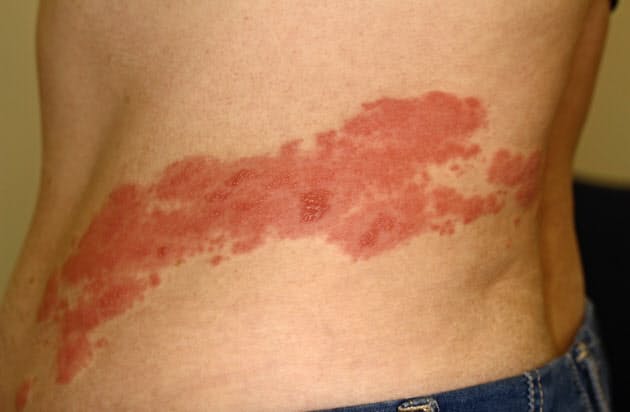 水ぼうそうウイルスで発症 帯状疱疹 ワクチンで予防 Nikkei Style 水ぼうそうウイルスで発症 帯状疱疹 ワクチンで予防 Nikkei Style