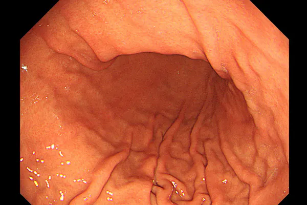 内視鏡で異常なし なぜか続く胃の不快感の原因は Nikkei Style