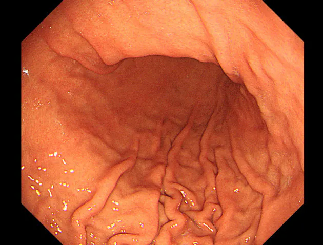 長引く胃もたれ 機能性胃腸症の可能性も Nikkei Style