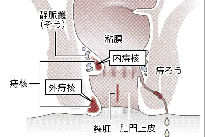 生活習慣から痔を防ぐ 食物繊維と水で腸内を調える Nikkei Style 生活習慣から痔を防ぐ 食物繊維と水で腸内を調える Nikkei Style