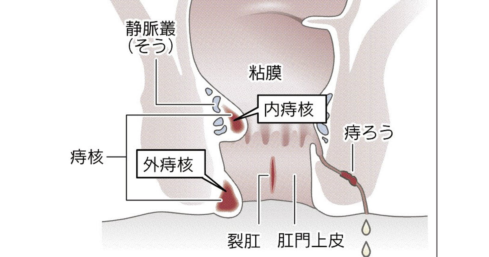 生活習慣から痔を防ぐ 食物繊維と水で腸内を調える Nikkei Style 生活習慣から痔を防ぐ 食物繊維と水で腸内を調える Nikkei Style