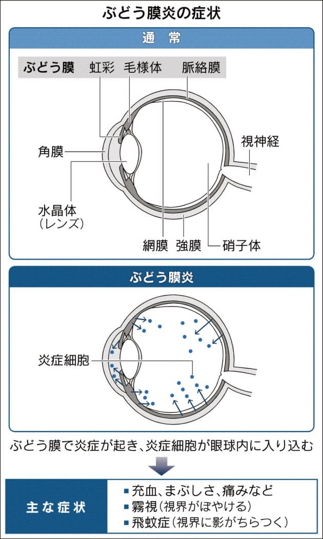 ぶどう膜炎 失明減る 新薬承認後10年 抑制効果 Nikkei Style ぶどう膜炎 失明減る 新薬承認後10年 抑制効果 Nikkei Style