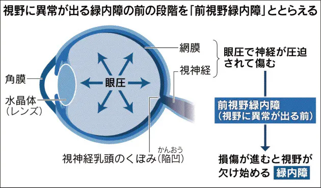 緑内障 障害出る前に治療 定期検査で神経の損傷把握 Nikkei Style