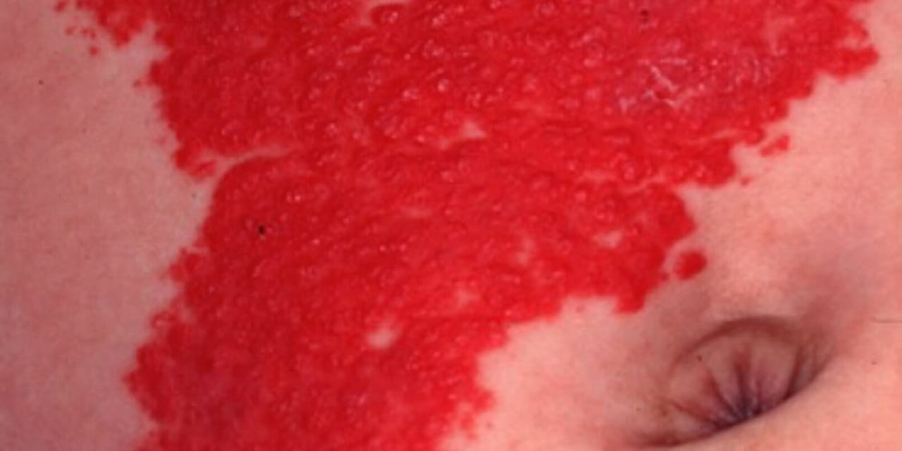 赤ちゃんの皮膚の赤いあざ 血管腫の飲み薬治療可能に Nikkei Style