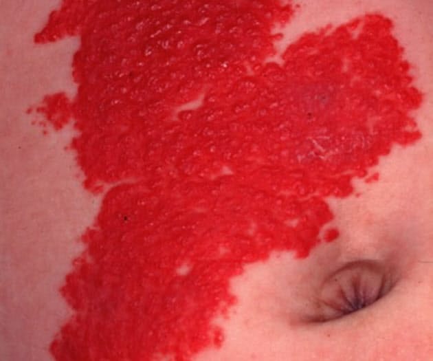 赤ちゃんの皮膚の赤いあざ 血管腫の飲み薬治療可能に Nikkei Style 赤ちゃんの皮膚の赤いあざ 血管腫の飲み薬治療可能に Nikkei Style