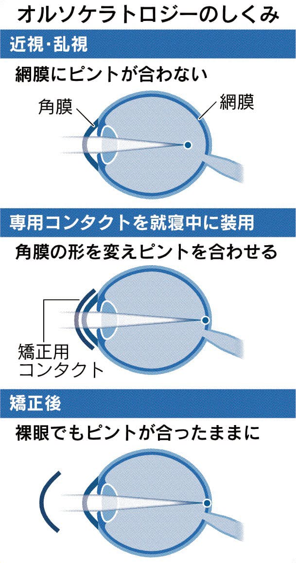 特別企画 近視矯正のための眼内レンズのお話 Medical Tribune