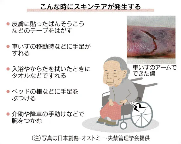 加齢で皮膚はがれる スキンテア 80 90代で増加 Nikkei Style