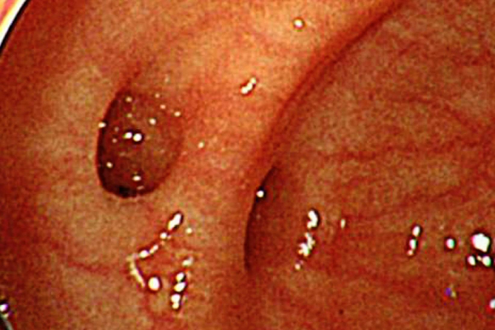 中高年襲う突然の大量下血 大腸憩室出血 に備える Nikkei Style 中高年襲う突然の大量下血 大腸憩室出血 に備える Nikkei Style