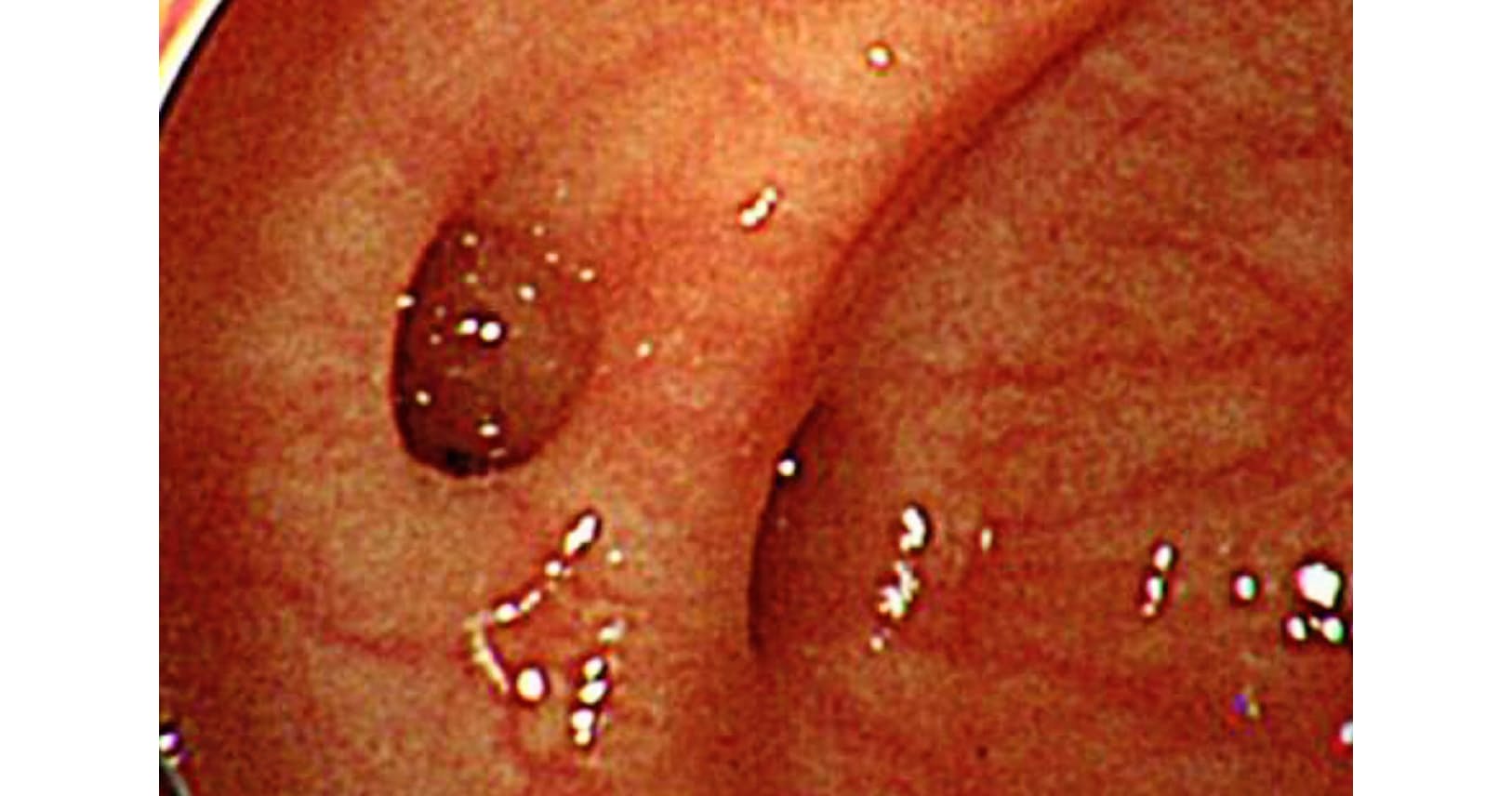 中高年襲う突然の大量下血 大腸憩室出血 に備える Nikkei Style 中高年襲う突然の大量下血 大腸憩室出血 に備える Nikkei Style