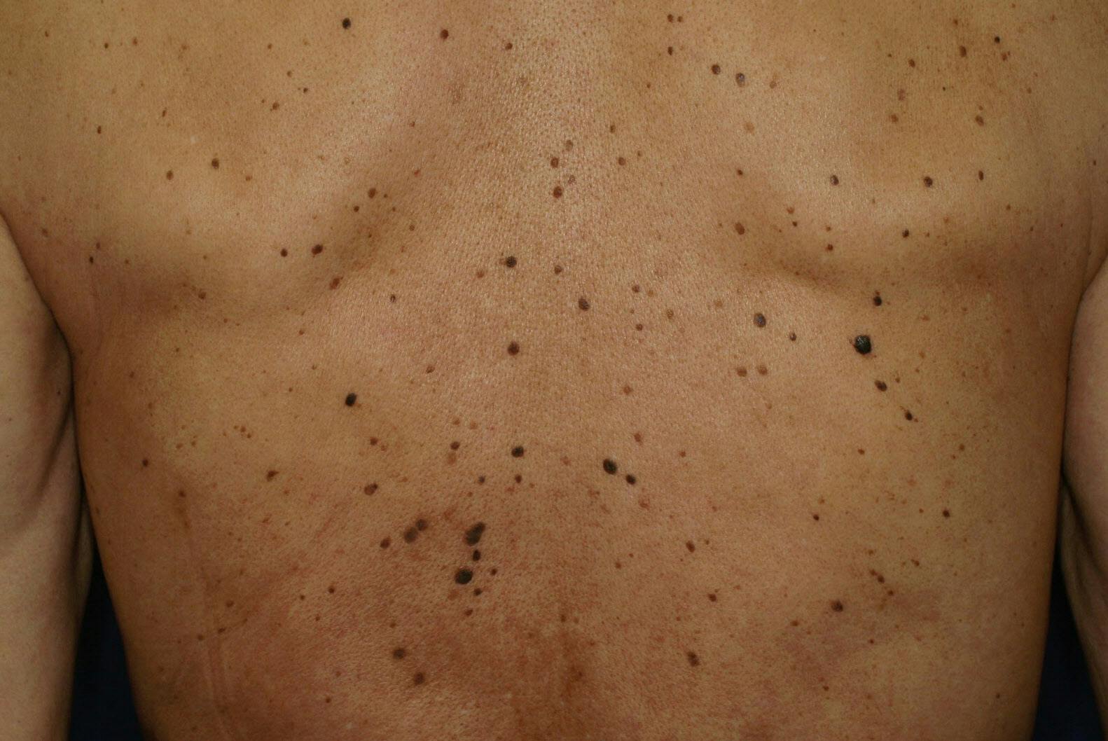 老人性いぼ 気になるなら受診 美容で除去する人も Nikkei Style