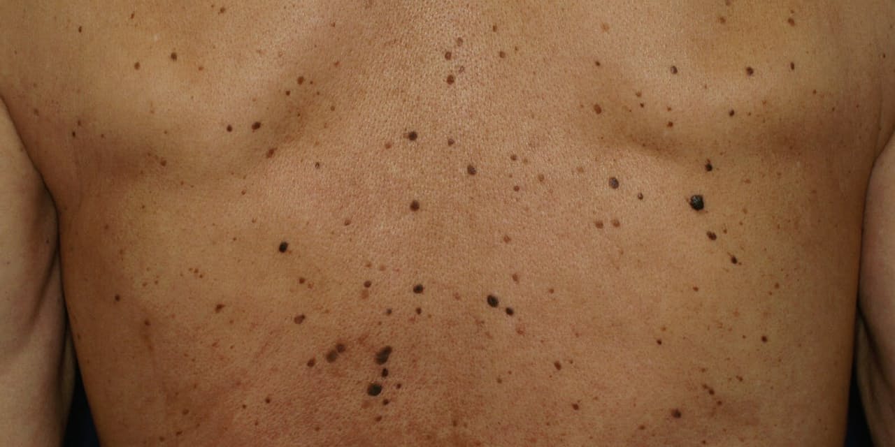 老人性いぼ 気になるなら受診 美容で除去する人も Nikkei Style 老人性いぼ 気になるなら受診 美容で除去する人も Nikkei Style