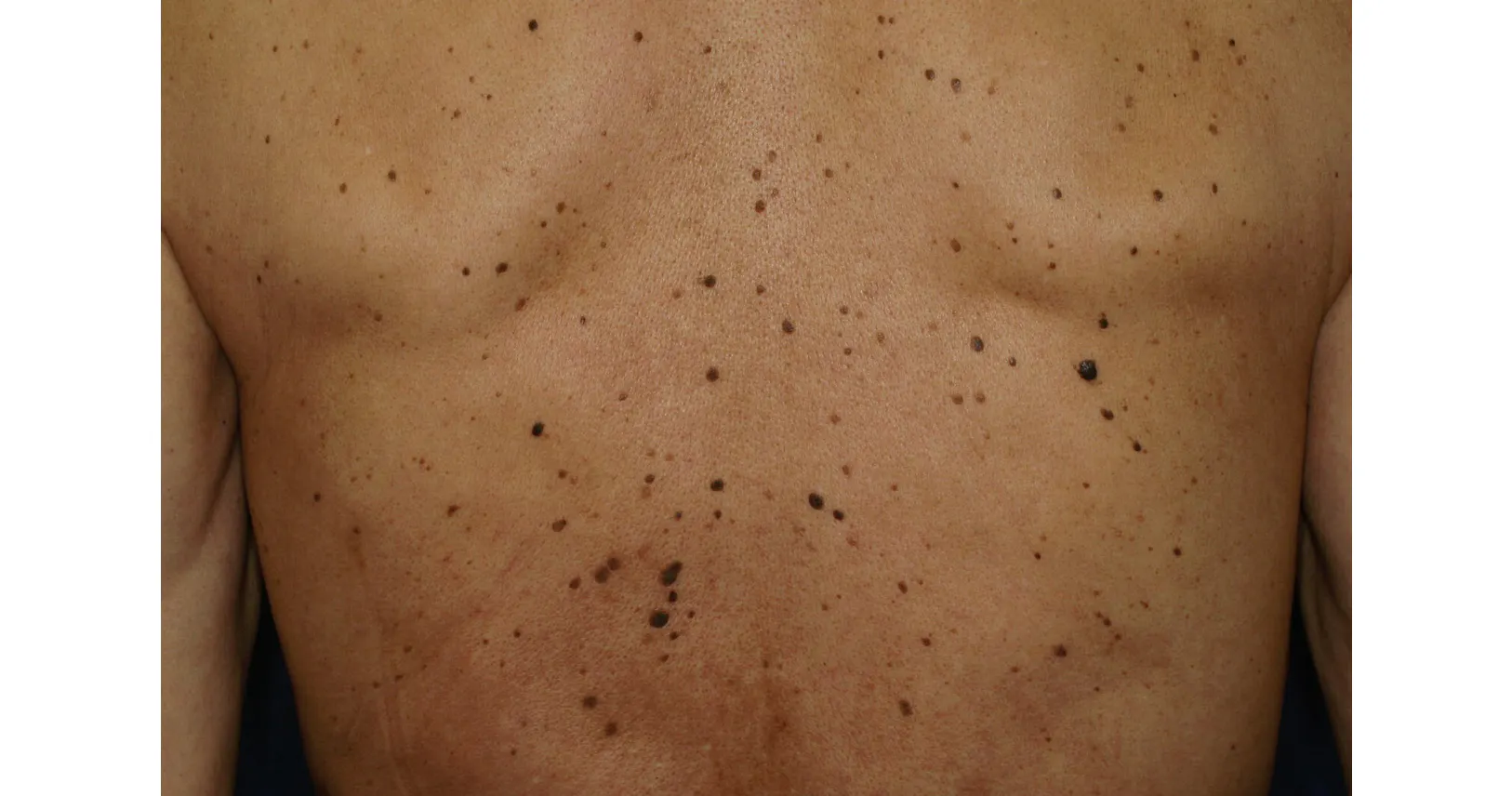 老人性いぼ 気になるなら受診 美容で除去する人も Nikkei Style