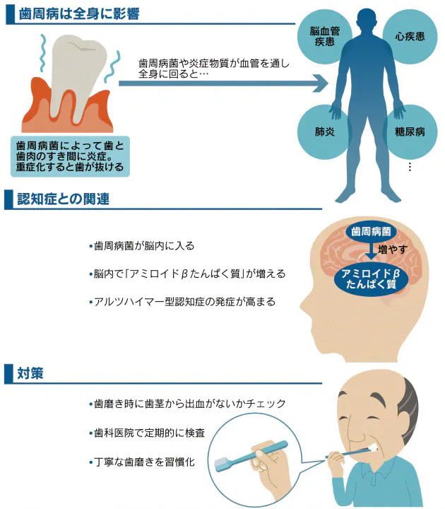 認知症の原因が明らかに 発症予防には歯周病対策を