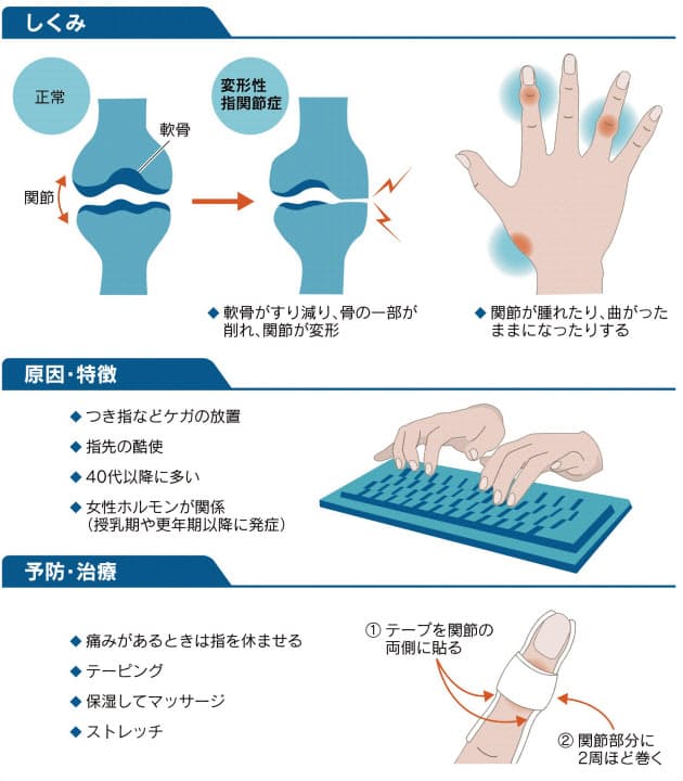 パソコン使い過ぎで指関節に痛み 早めのケアが大事 Nikkei Style パソコン使い過ぎで指関節に痛み 早めのケアが大事 Nikkei Style