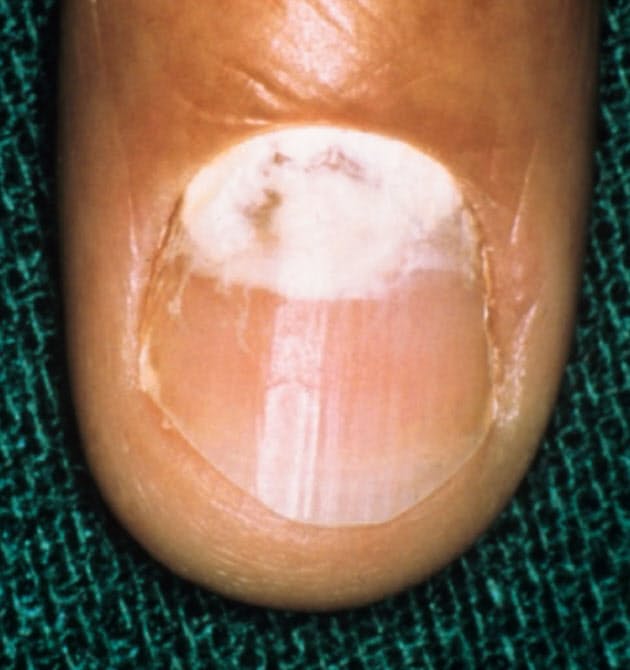 混同しやすい他の病気も 肌荒れ いえ水虫かも 梅雨時は要注意 早めに受診 Nikkei Style 混同しやすい他の病気も 肌荒れ いえ水虫かも 梅雨時は要注意 早めに受診 Nikkei Style