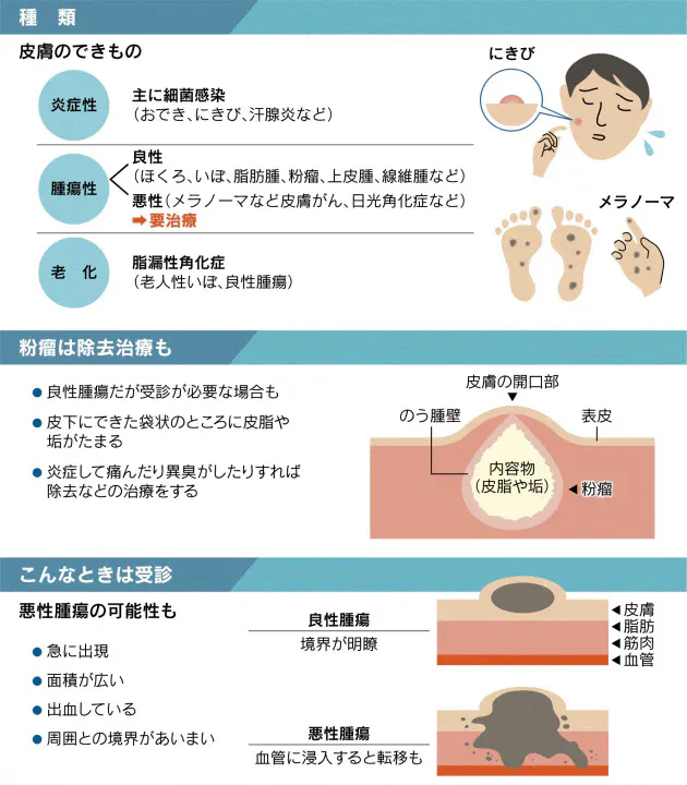 皮膚の できもの 正しく対処 痛みだけで判断しない Nikkei Style