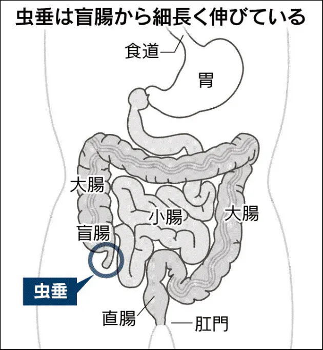強い痛み 血圧急低下 大人の盲腸 重症化に注意 Nikkei Style