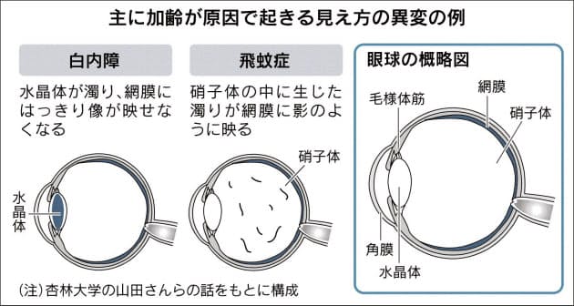 視野欠ける チカチカする こんな見え方は要注意 Nikkei Style 視野欠ける チカチカする こんな見え方は要注意 Nikkei Style