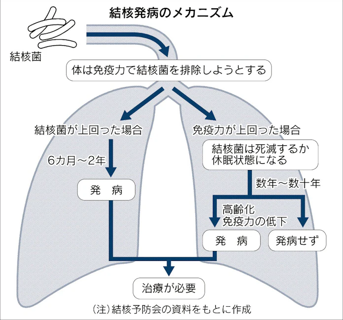 まだ怖い結核 せき長引くなら受診 薬飲み切って 日本経済新聞