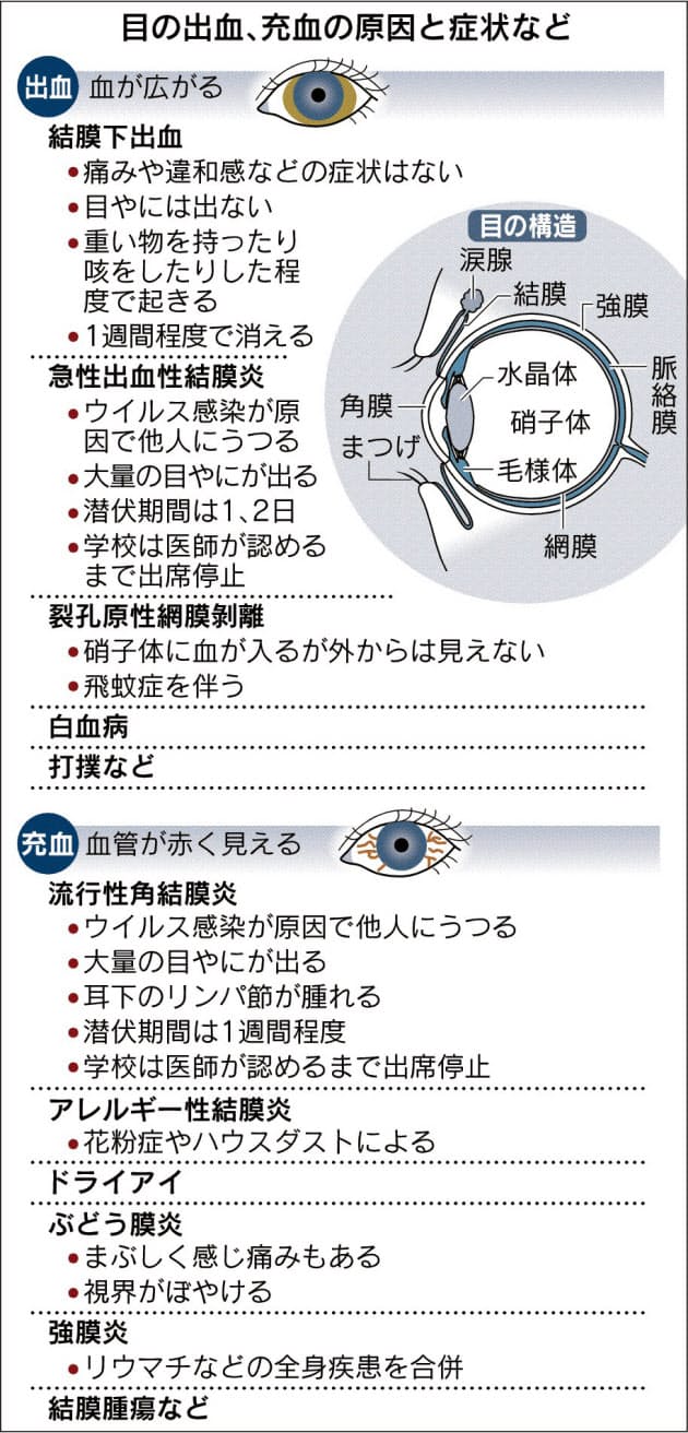 目が真っ赤 結膜下出血 充血に気をつけよう Nikkei Style 目が真っ赤 結膜下出血 充血に気をつけよう Nikkei Style