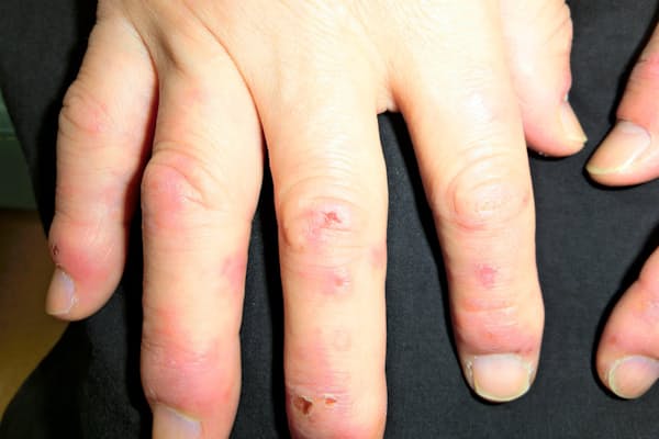 足のかゆみ 水虫か 正確な判定は顕微鏡で Nikkei Style 足のかゆみ 水虫か 正確な判定は顕微鏡で Nikkei Style