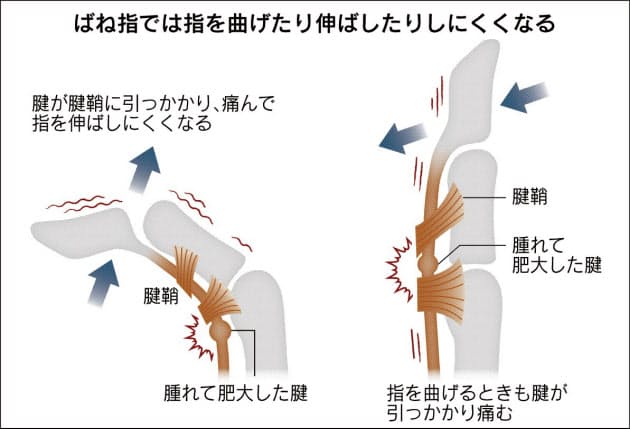 スマホ使い過ぎ 腱鞘炎からばね指に 手術も選択肢 Nikkei Style スマホ使い過ぎ 腱鞘炎からばね指に 手術も選択肢 Nikkei Style